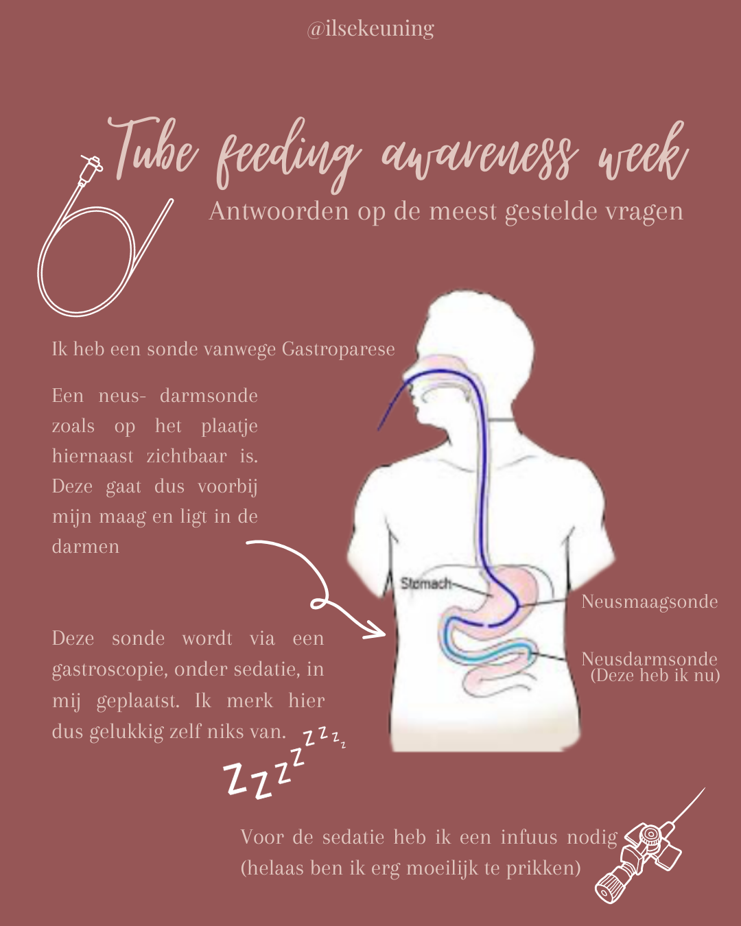 Sondevoeding uitleg 1